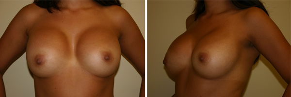 Holley-Surgical-Arts-Breast-Enhancements-Stuart-Port-St-Lucie-Florida