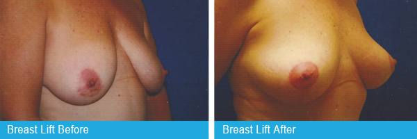 Holley-Surgical-Arts-Breast-lift