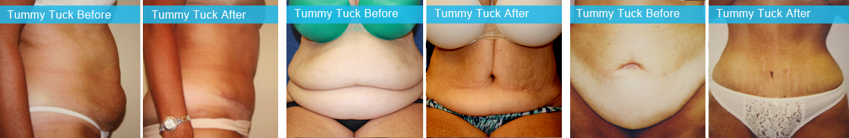 tummy tuck recovery