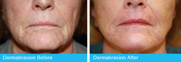 Dermabrasion Holley Surgical Arts