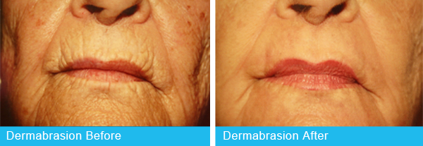 Dermabrasion Holley Surgical Arts