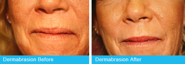 Dermabrasion Holley Surgical Arts